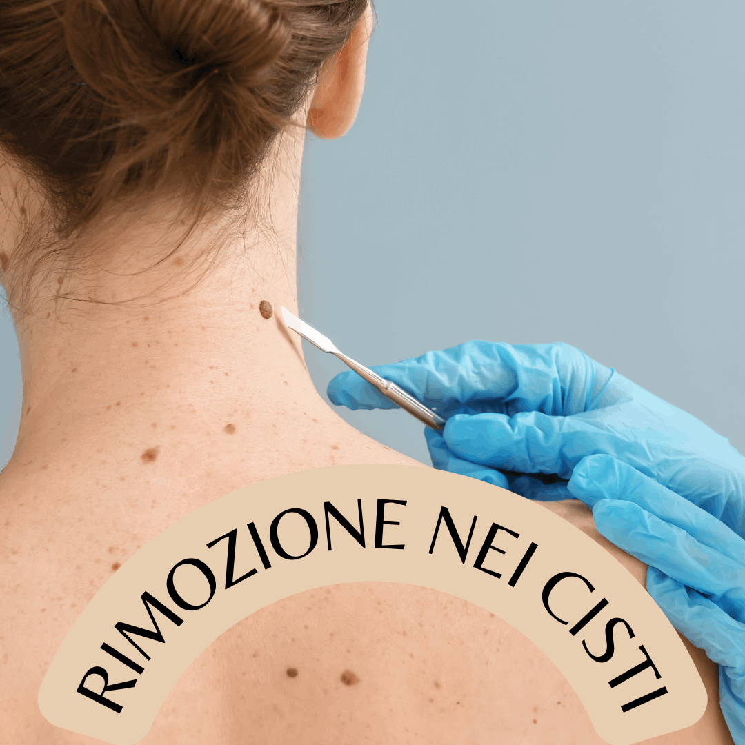 Rimozione Nei e Cisti