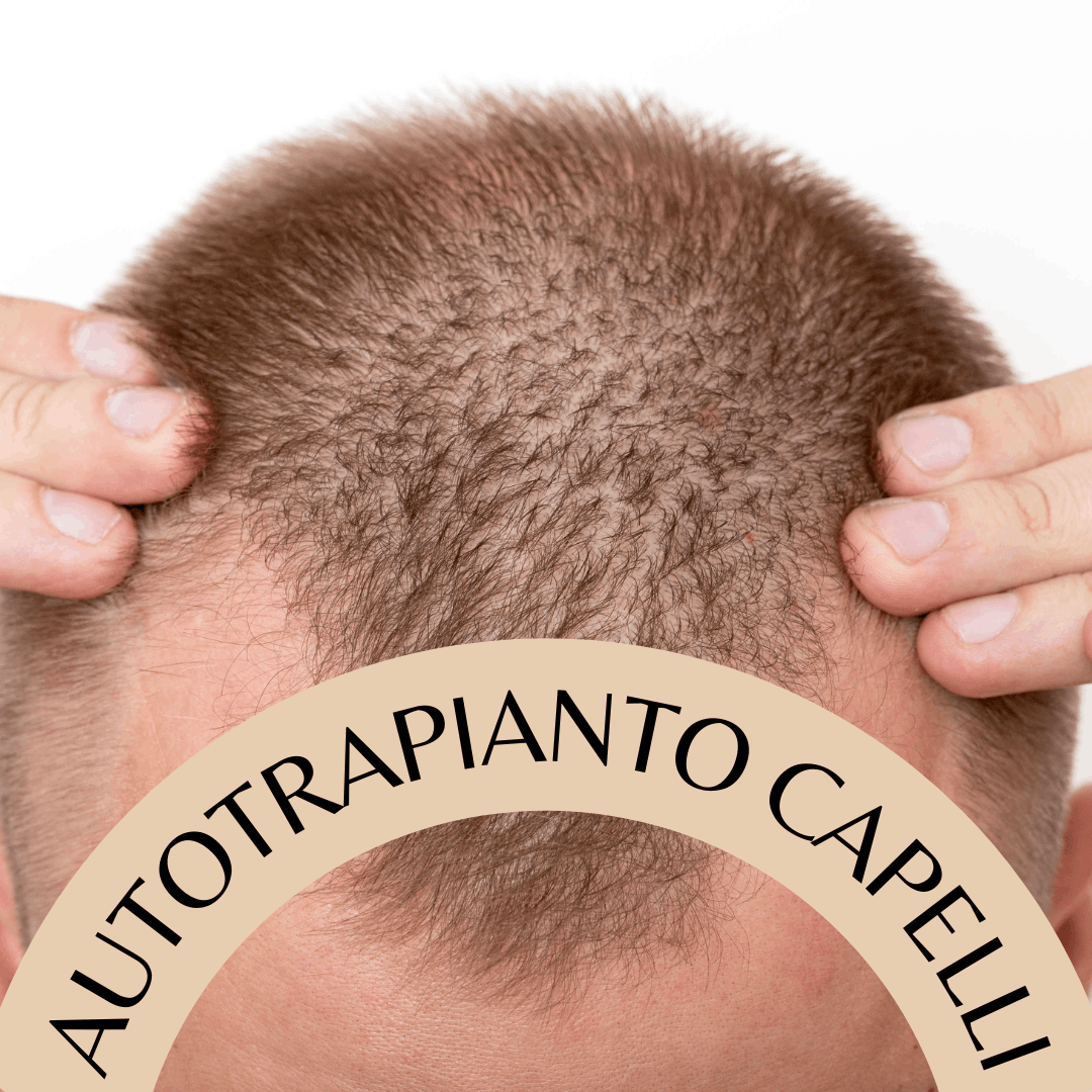 Autotrapianto Capelli