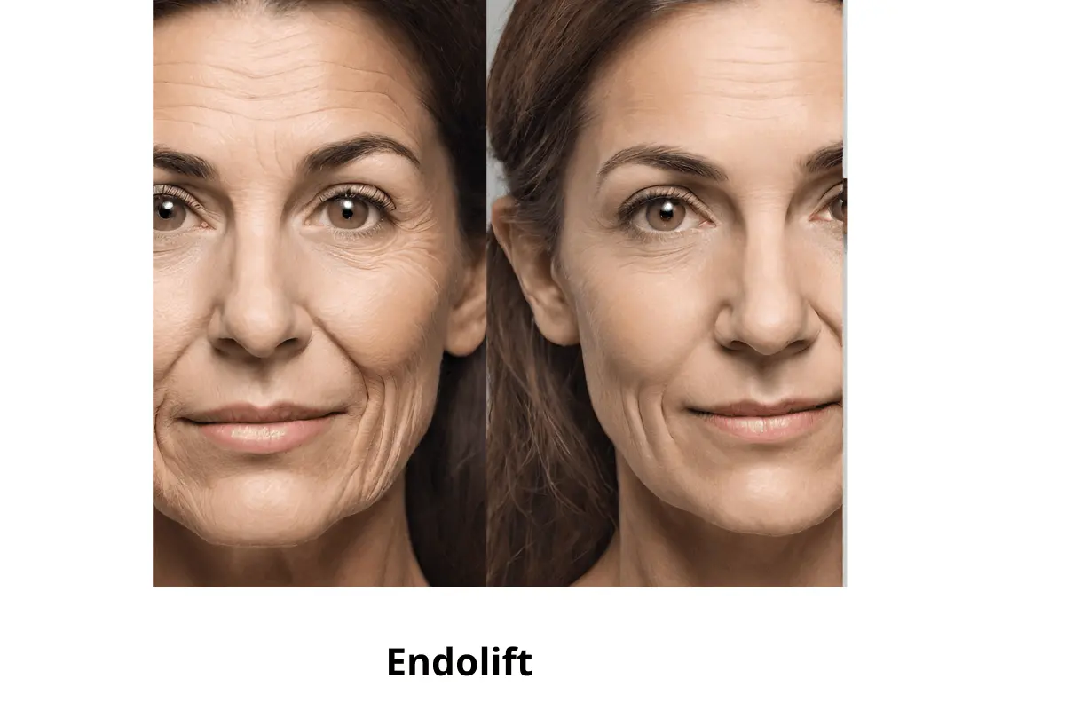 Endolift