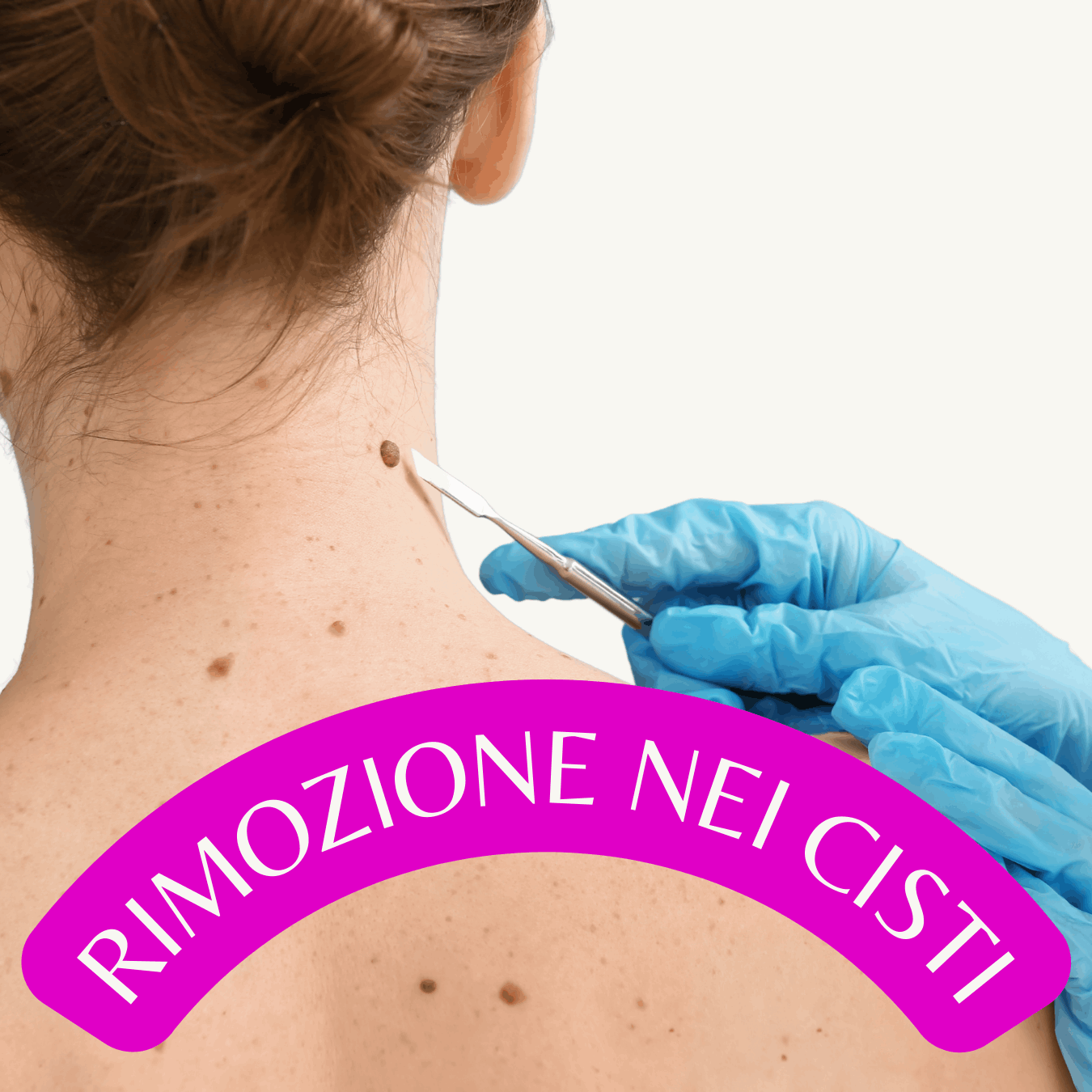 Rimozione Nei e Cisti