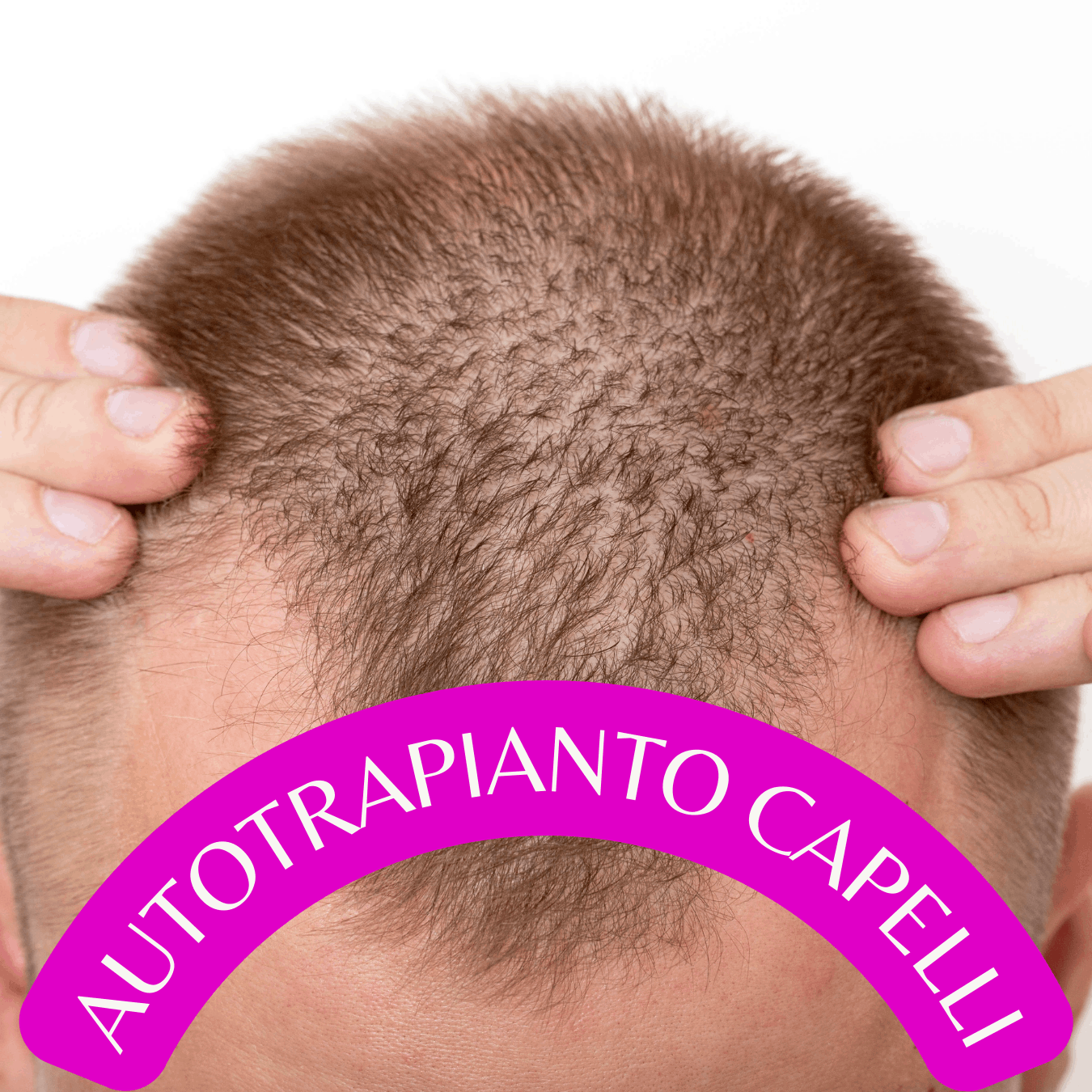 Autotrapianto Capelli