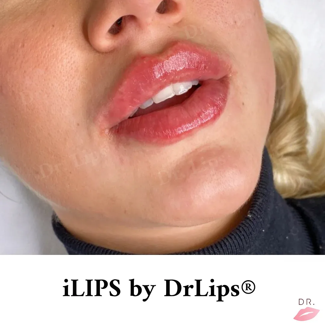 Filler labbra balance clinic