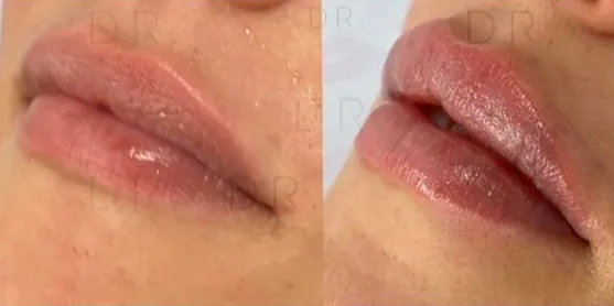 Filler labbra balance clinic