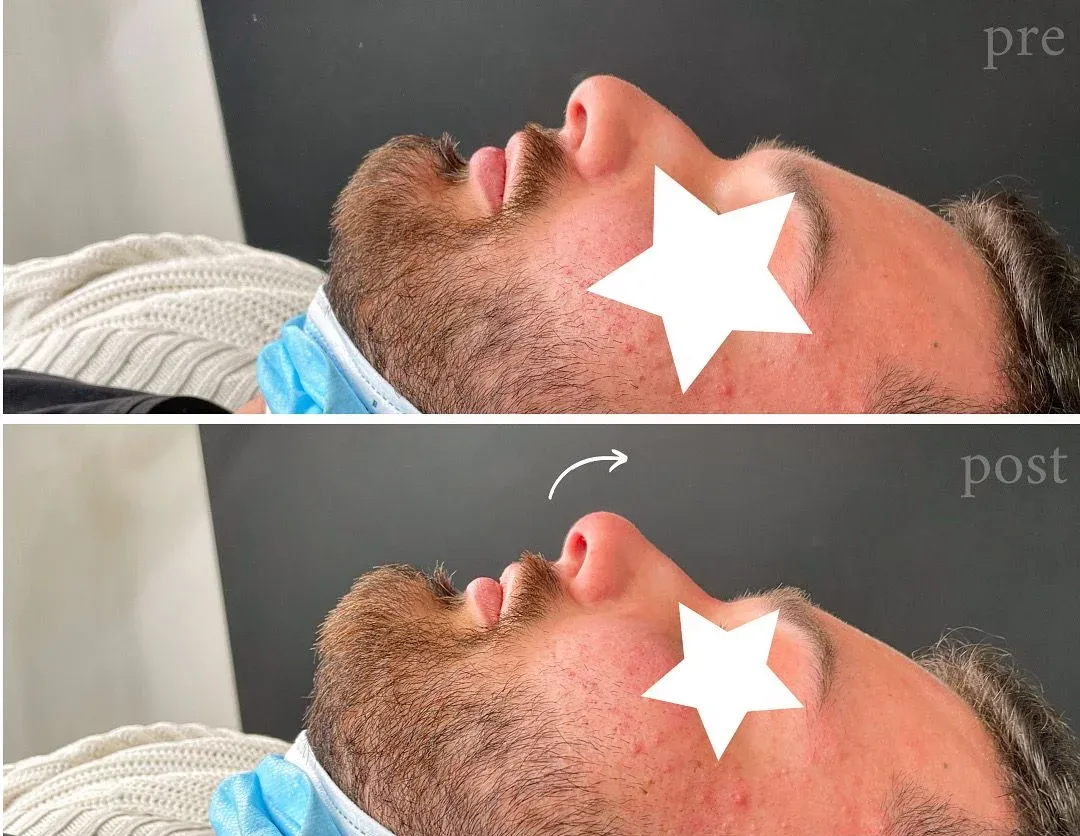 Rinofiller pre e post